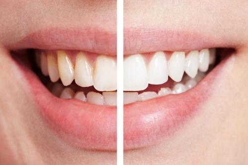 différence dent avec et sans plaque dentaire