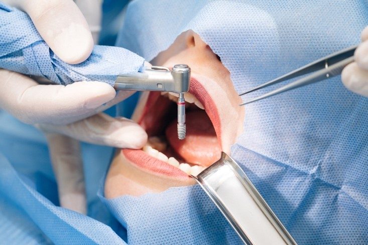 prothèse sur implant