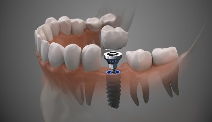 prothèse sur implant