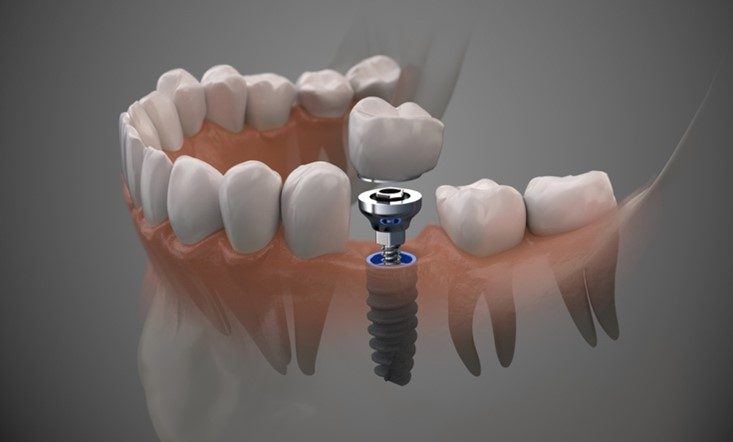 Prothèse dentaire sur implant fixe ou clipsée : décryptage
