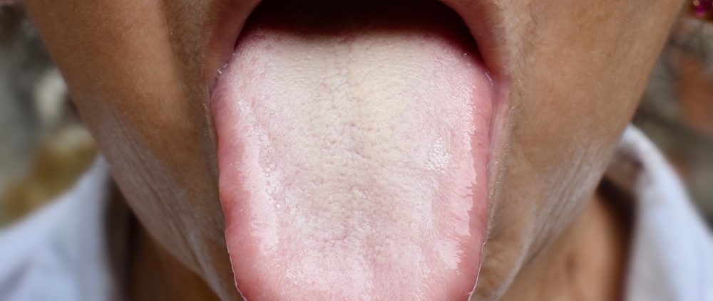 Comment reconnaître la langue blanche ?