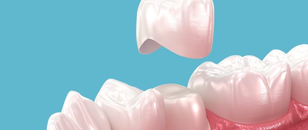 Pourquoi changer une couronne dentaire ?