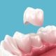 Pourquoi changer une couronne dentaire ?
