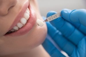 Restaurations dentaires collées