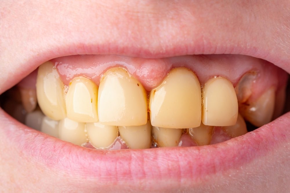 Le vapotage et le jaunissement des dents